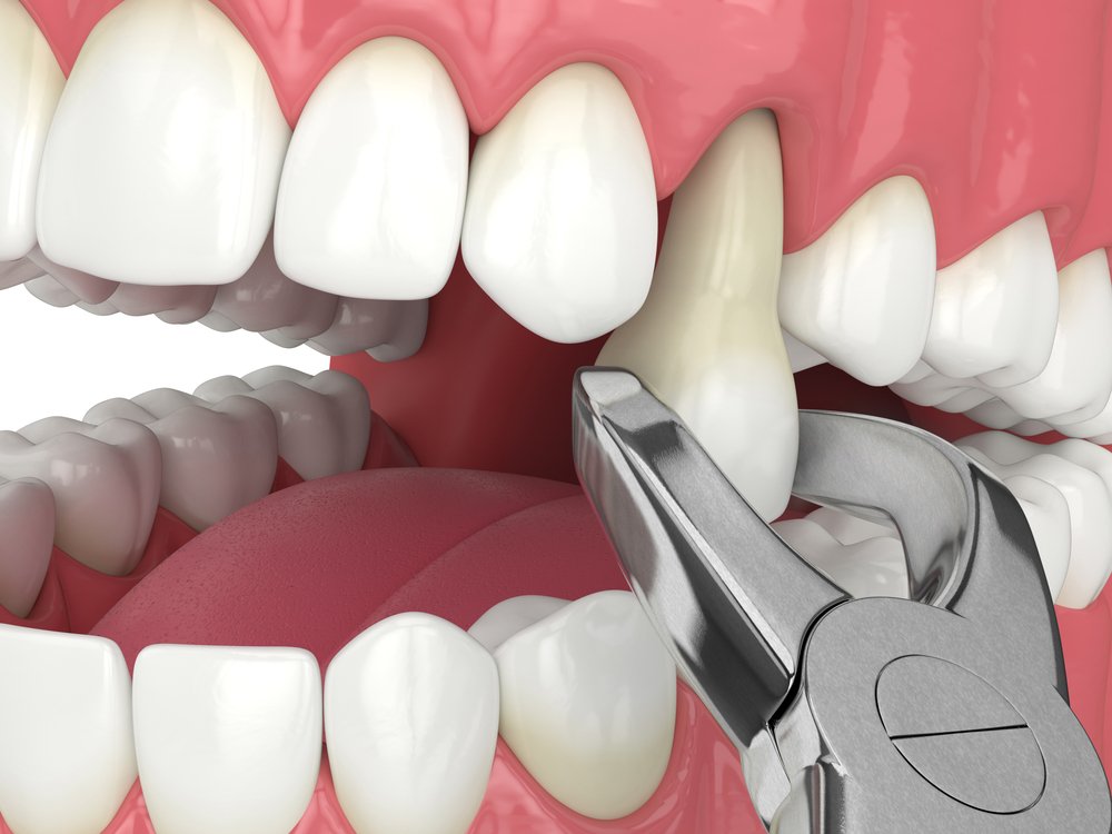Best Tooth Extraction Doctors in Bangalore - DDC Smiles