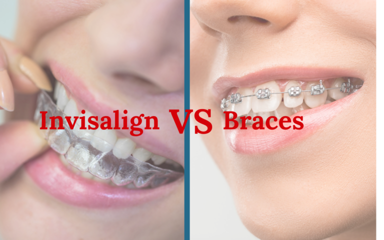 Braces vs Invisalign Aligners: Pros and Cons – Which Is Better?