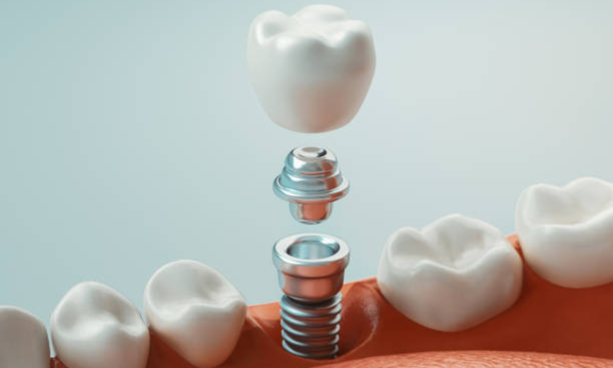 Dental Implants in Koramangala