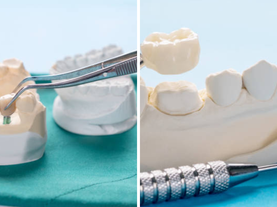 Dental Implants in HSR Layout