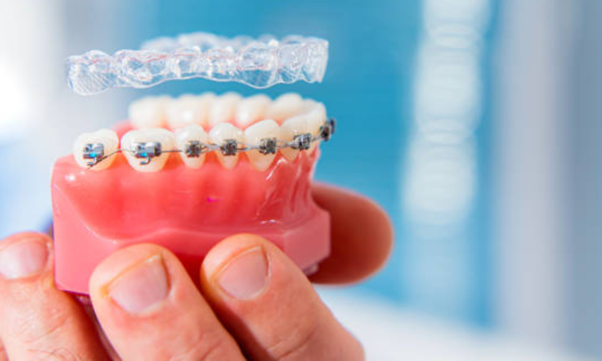 Clear aligners