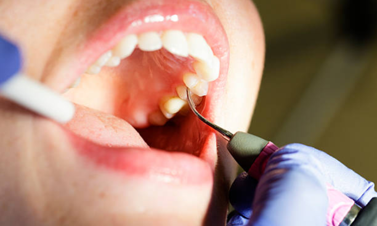 Advanced gum treatment
