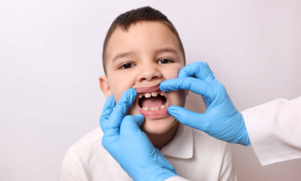 Braces and Aligners in HSR Layout and Koramangala