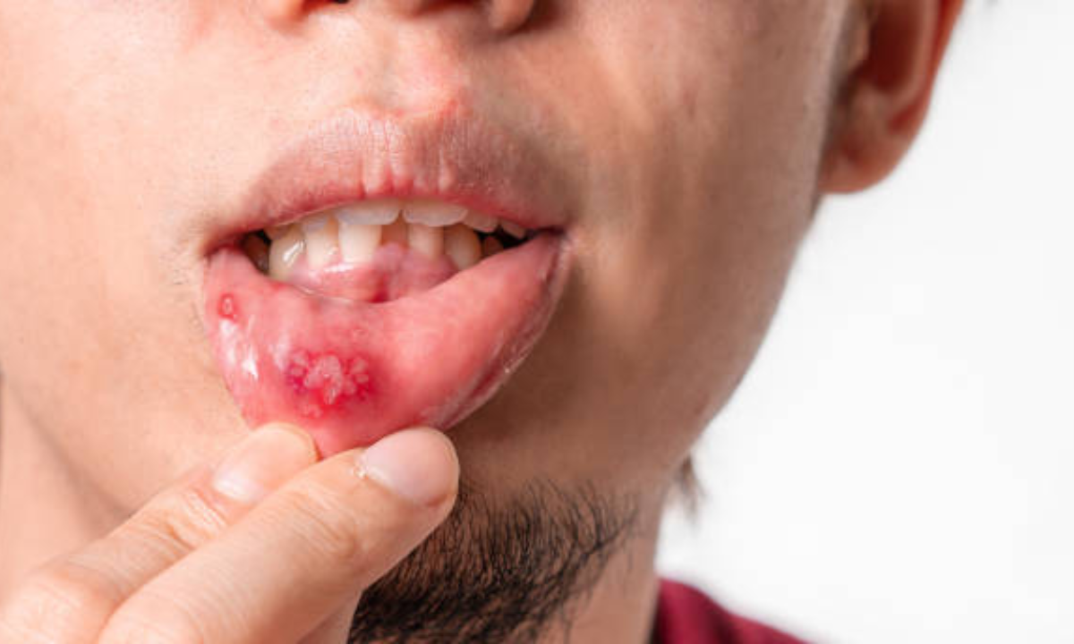 Mouth ulcers treatment in HSR layout & Koramangala