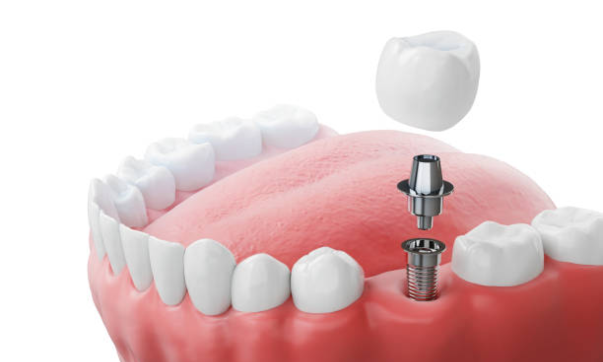 Dental Implants in HSR layout and Koramangala