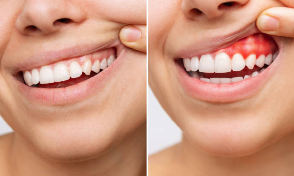 Gum Treatment in HSR layout and Koramangala