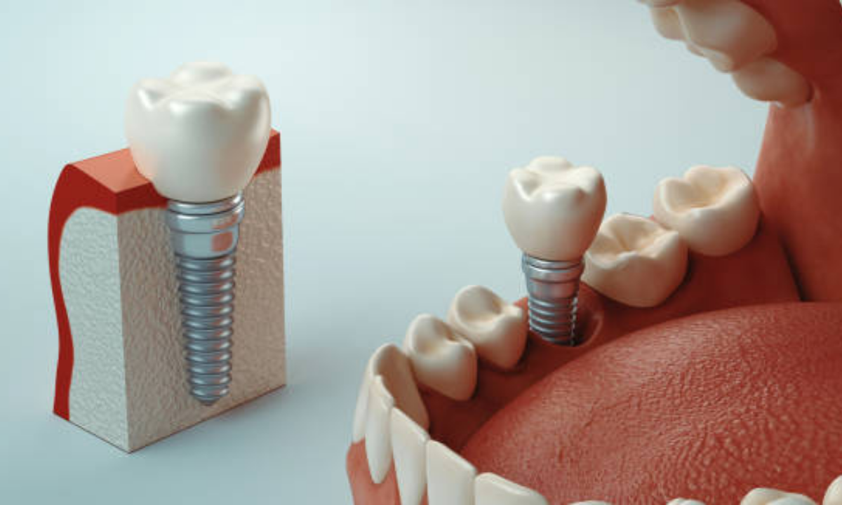 Dental implant 