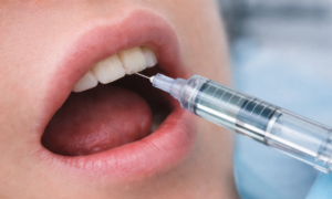 Anesthesia for root canal treatment