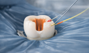 Filling the canals of the tooth