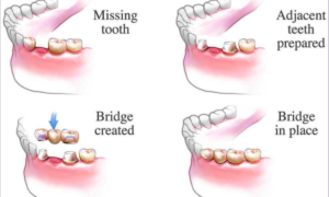 How does dental bridge treatment work