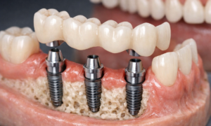 Implant-Supported Dental Bridges