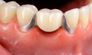 Maryland Dental Bridges
