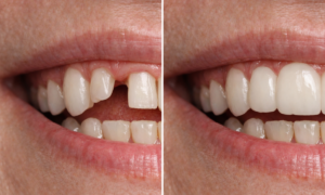 Teeth Bridge Before and After