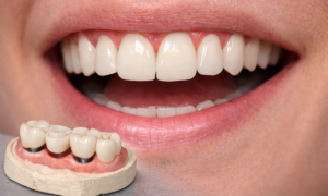 Traditional Dental Bridges