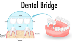 What Are Dental Bridges?