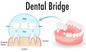 What are dental bridges?