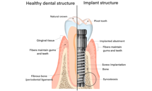 What Are Dental Implants?