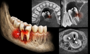 CBCT (Cone Beam Computed Tomography)