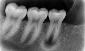 IOPA (Intra-Oral Periapical Radiograph)