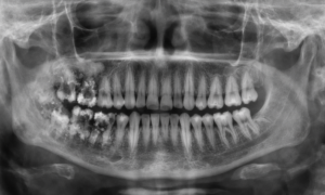 OPG (Orthopantomogram)