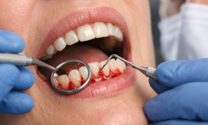 Checking for Gum Disease