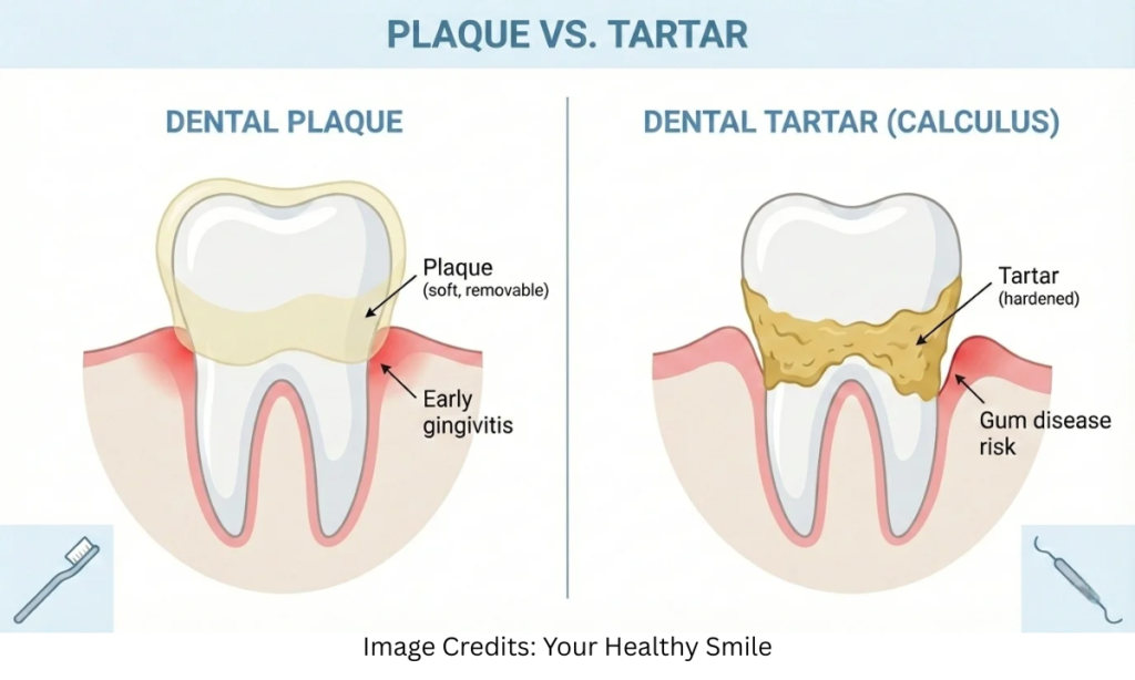 Understanding Dental Plaque and Tartar