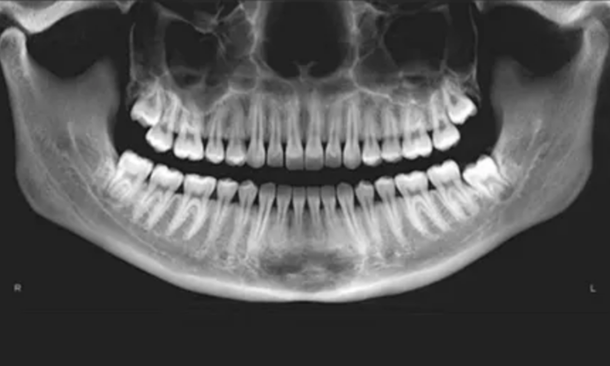 What is an OPG X-ray?