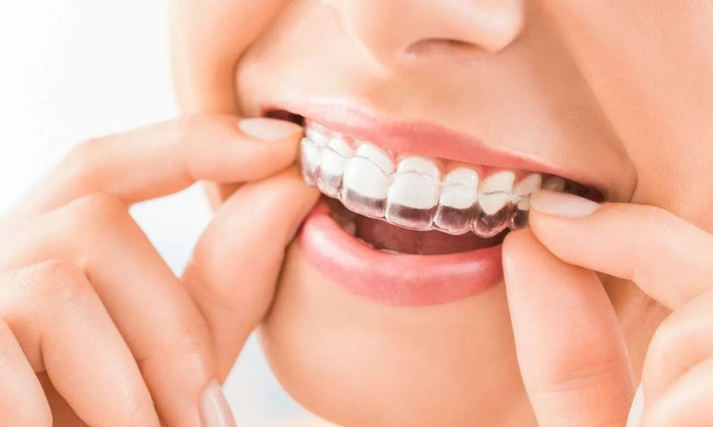 Clear Aligners Treatment