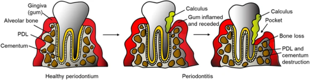 Periodontitis Bone Loss Illustration