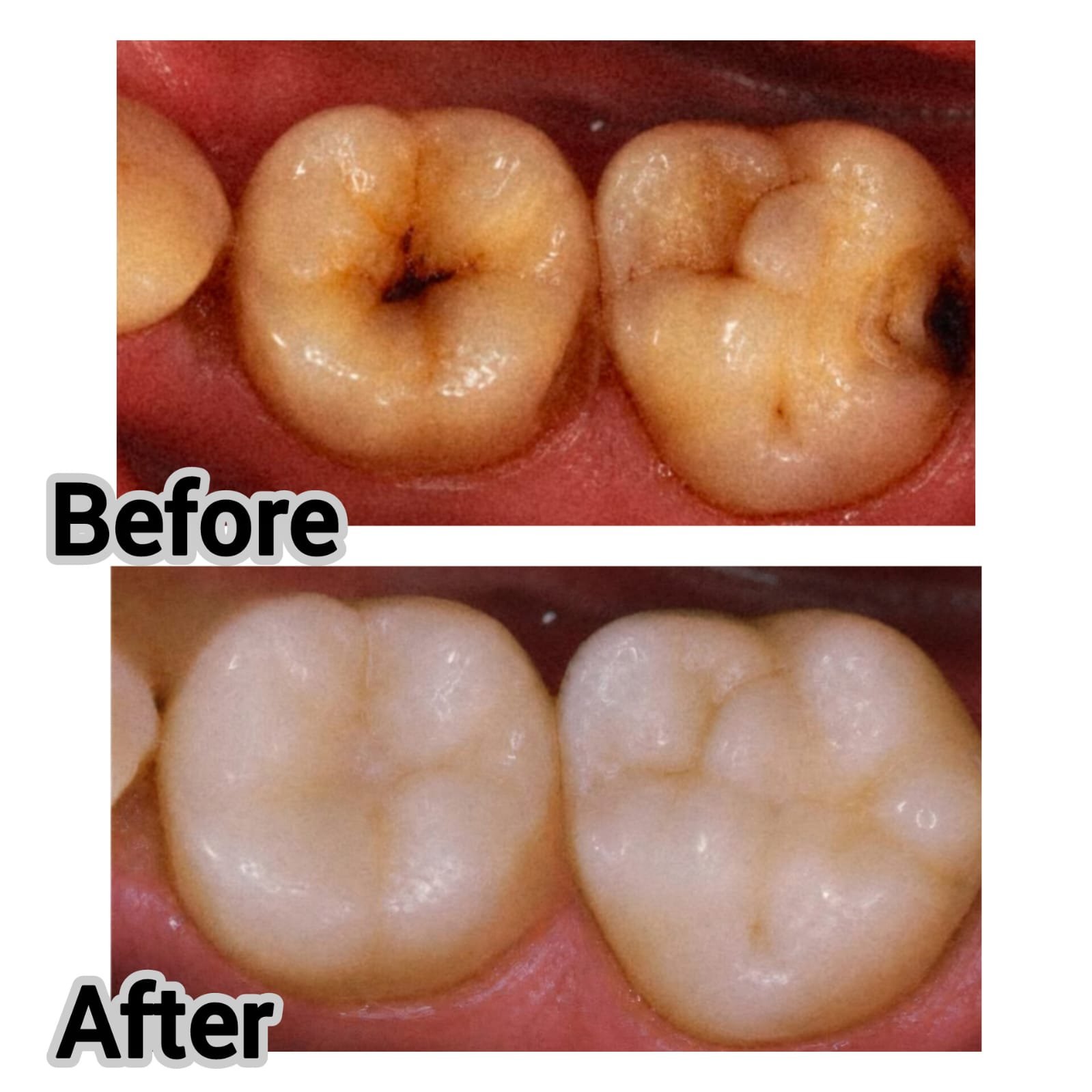 dental cavity treatment