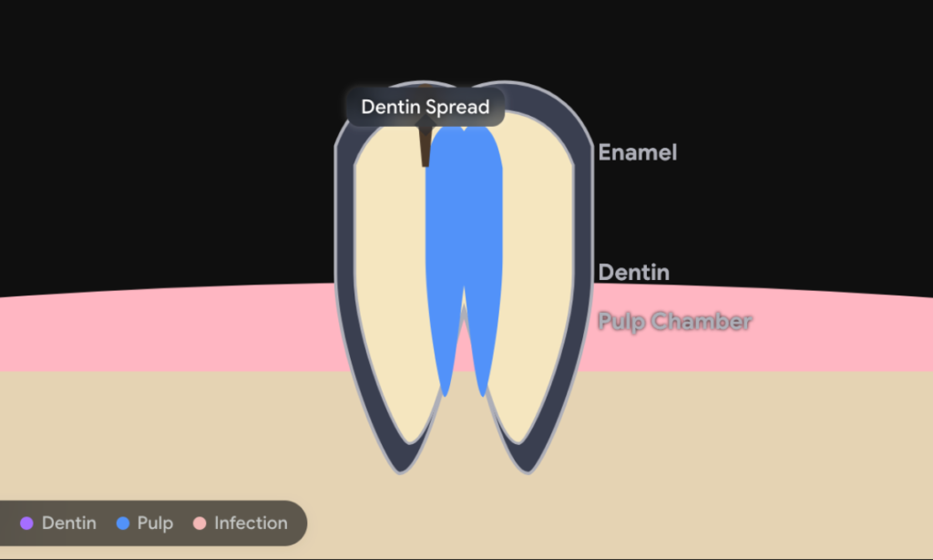 Dentin Invasion