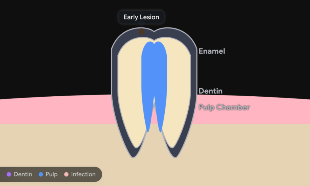 Enamel Decay