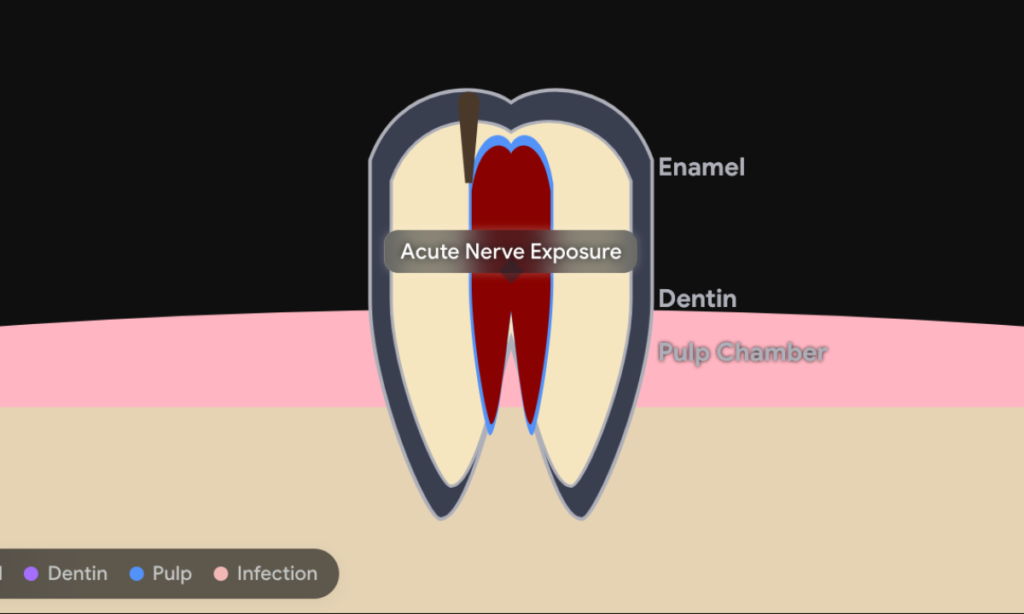 Pulpitis