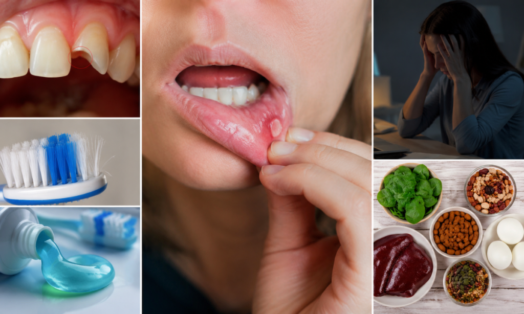 What Causes Mouth Ulcers?