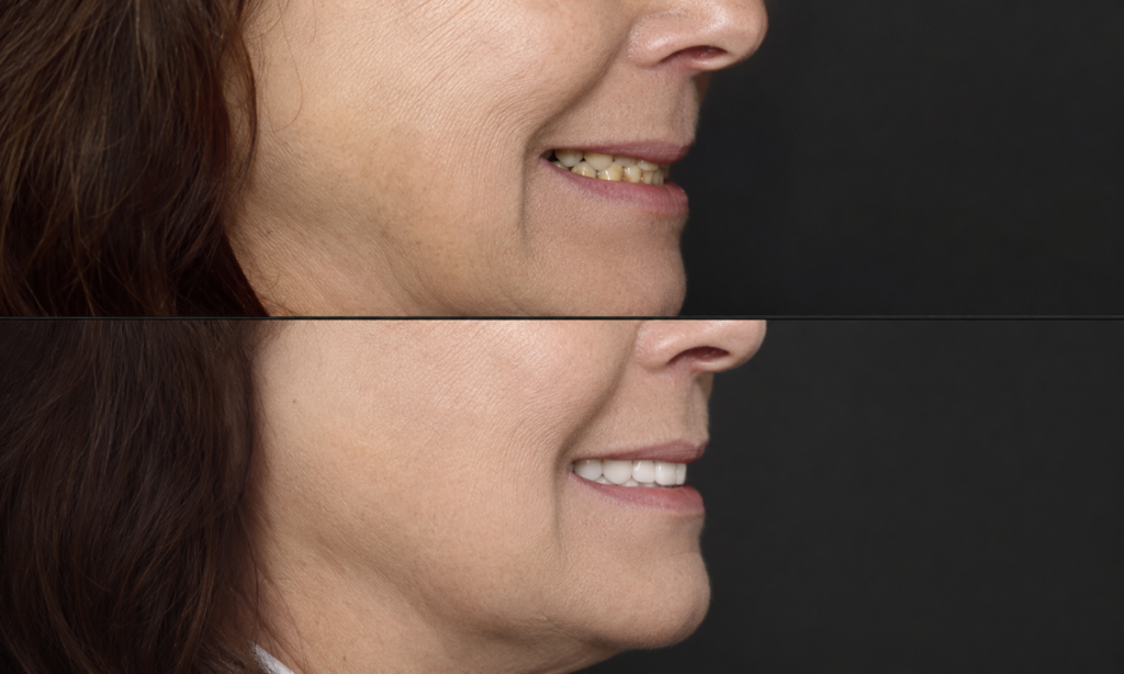 Restoring Bite Height